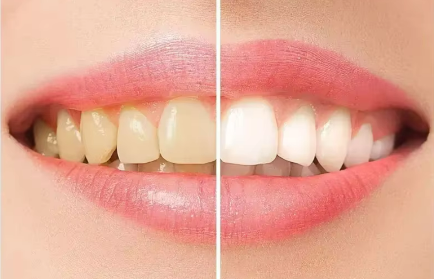 Teeth Whitening Kit